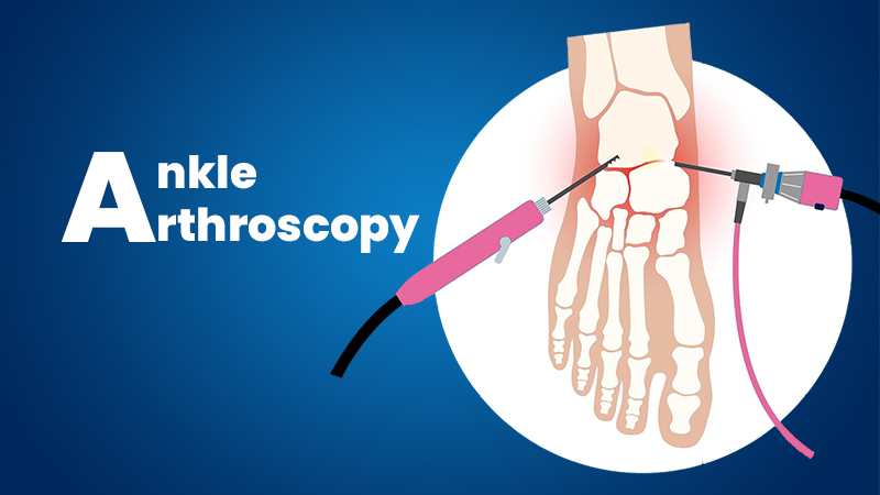 ankle-arthoscopy.jpg